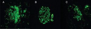 IFI 40 X. Presencia de depósitos reactivos para IgG A), IgA B) y C1q C) en membrana basal capilar glomerular y mesangio.