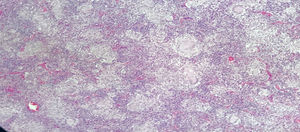 Primera histopatología ganglio cervical, caso 2. Inflamación crónica granulomatosa sin necrosis-coloraciones negativas para BK, GOMORI- y WS.