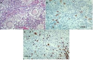 Segunda histopatología ganglio cervical, caso 2. A) Ganglio linfático con distorsión de su arquitectura, células grandes, lobuladas, binucleadas y mononucleadas, con nucléolo prominente, células gigantes multinucleadas. Se observa además fibrosis y colagenización del estroma. B y C) Las células neoplásicas descritas expresan CD30, CD15, MUM-1, PAX-5 y la proteína latente de membrana 1 (LMP-1). La población linfoide acompañante es de predominio T ayudador CD3, CD4, CD2, CD7, CD5, CD25 con poco CD8. Compatible con linfoma de Hodgkin clásico, esclerosis nodular.