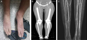 Ergotism (A) Livedo reticularis after 4 days taking ergotamine. (B) Decreased flow of contrast in both legs in angioCT. (C) Contrast MRI with 3D reconstruction after stopping ergotamine and recovery of normal distal perfusion.