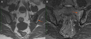 RNM de articulaciones sacroilíacas. A) Secuencia T1. Se observan erosiones en la articulación sacroilíaca izquierda (flecha). B) Secuencia STIR. Se observa edema óseo subcondral (flecha) en los cuadrantes superior e inferior del sacro izquierdo.