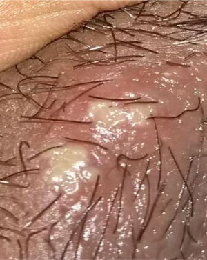 Úlcera genital en el labio mayor.