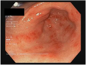 Ectasia vascular antral gástrica en un paciente con esclerosis sistémica.