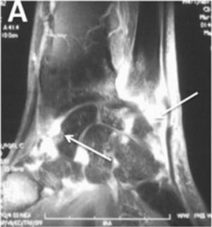 Detección de compromiso inflamatorio de articulaciones y tendones con RM (flechas). Adaptado con permiso de Avouac et al.1.