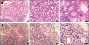 Histopathological features of MSGB. Hematoxilin and eosin staining of minor salivary glands from A. Patient with non-specific chronic sialadenitis characterized by focal or scattered cell infiltrate adjacent to apparently normal acini and B. Patient with SS characterized by focal lymphocytic sialadenitis defined as the presence of ≥50 mononuclear cells in perivascular or periductal areas.