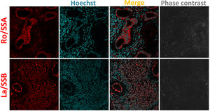 Ro/SSA and La/SSB subcellular location in MSGB by indirect immunofluorescence. 4um-thick MSGB sections were tested with rabbit polyclonal anti-Ro/SSA/TRIM21 (ab91423) and rabbit monoclonal anti-La/SSB (ab124932). Secondary fluorescent antibody was goat anti-rabbit IgG alexa fluor 546 (red) mixed with Hoechst (blue) used to stain nucleic acids. The subcellular location of Ro/SSA antigen is nuclear and cytoplasmic. Ro/SSA is mainly found in the cytoplasm, whereas La/SSB is observed in nuclei.