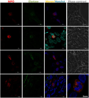 Presence of neutrophils in MSGB from SS patients with FS ≥1. NET components in 4μm-thick MSGB sections were evaluated by double sequential immunofluorescence. Colocalization of MPO (red) with elastase (green) was detected using rabbit polyclonal anti-MPO (ab9535) and mouse monoclonal anti-neutrophil elastase (sc-55549). Secondary fluorescent antibodies were goat anti-rabbit IgG alexa fluor 546 (A-11010) and goat anti-mouse IgG alexa fluor 488 (A-11001) mixed with Hoechst or DAPI (blue) used to stain nucleic acids.
