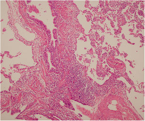 Microfotografía del corte histológico pulmonar con hematoxilina-eosina que muestra pérdida de la arquitectura normal de los septos, secundaria a una infiltración marcada de células mononucleares. No se observan centros linfoides. Patrón de una neumonía intersticial linfocítica.