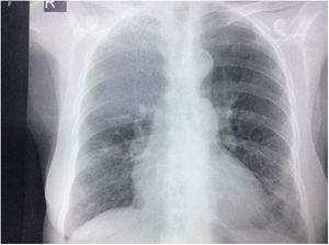 Radiografía de tórax con proyección postero-anterior en la que se observan opacidades intersticiales, presencia de nódulos con densidad cálcica de aproximadamente 8 a 9 mm en el tercio superior de hemitórax derecho, prominencia del botón y calcificación ateromatosa aórticas, además de cardiomegalia, sin derrames pleurales.
