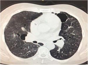 Corte axial de la tomografía de alta resolución de tórax (TACAR de tórax) que evidencia múltiples quistes de pared delgada de predominio central, zonas de atenuación en vidrio esmerilado subpleural y un nódulo calcificado de aproximadamente 6 mm de diámetro.