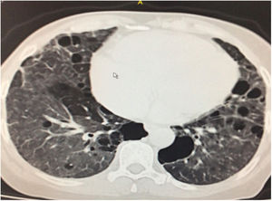 Corte axial de la TACAR con evidencia de múltiples quistes de pared delgada, engrosamiento septal subpleural e interlobular y nódulos de distribución centrolobulillar.