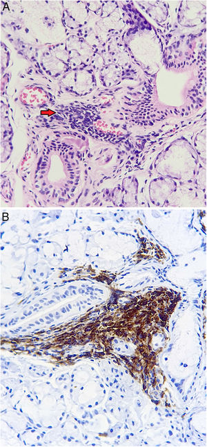 Patología de glándula salival menor. Sialoadenitis linfocítica focal, agregado de más de 50 linfocitos (flecha), adyacente a acinos y un ducto de apariencia usual. A. Hematoxilina-eosina. B. Positividad de linfocitos para CD45 evaluado por inmunohistoquímica.