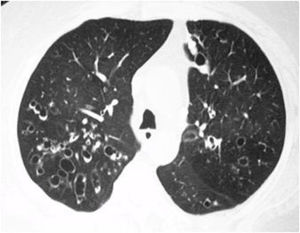 Signos de enfermedad de la vía aérea en paciente con SSj. La tomografía computarizada de tórax de alta resolución evidencia bronquiectasias quísticas de predominio en lóbulos superiores asociadas con patrón de atenuación en mosaico.