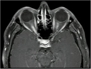 Neuritis óptica bilateral longitudinalmente extensa. Resonancia magnética con gadolinio en corte axial que muestra extenso realce del nervio óptico bilateral.