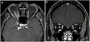 Neuritis óptica derecha longitudinalmente extensa. Resonancia magnética con gadolinio que muestra extenso realce del nervio óptico derecho en corte axial (A) y corte coronal (B).