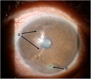 Ojo izquierdo, una semana después del inicio de tratamiento: a) zona de derretimiento con mejoría de superficie corneal. b) Úlcera inferior de menor tamaño.