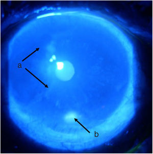 Ojo izquierdo, una semana después del inicio de tratamiento, tinción con fluoresceína y visualización con luz azul de cobalto. a) Área nasal con mejoría de la superficie, sin tinción negativa. b) Úlcera inferior de menor tamaño.