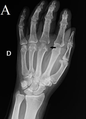 Radiografía simple PA de enfermedad de Dieterich; tercer metacarpiano mano derecha.