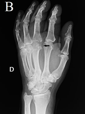 Radiografía simple oblicua de enfermedad de Dieterich; tercer metacarpiano mano derecha.