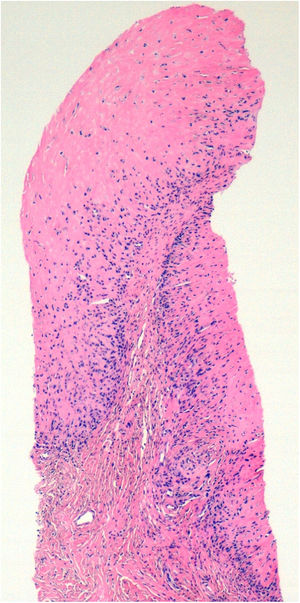 Los hallazgos histopatológicos muestran grandes áreas de necrosis fibrinoide rodeadas por una inflamación granulomatosa constituida por histiocitos elongados y linfocitos (hematoxilina-eosina; NR 1: ×50; NR 2: ×100).