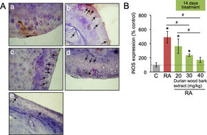 The expression of iNOS in chondrocytes of articular cartilage. (A) representative images of iNOS expression in the articular cartilage; (a) control; (b) RA model; (c–e) RA model treated with durian wood bark extract at dosages of 20, 30, and 40mg/kg, respectively. The images were taken at 1000× magnification. (B) Quantification of iNOS expression. Data are expressed as a mean±standard deviation (SD). (*) and (#) indicates a significant difference compared to control and between two groups indicated in the graphs (p<0.05), respectively.