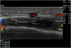 Signo del Halo en ultrasonido-doppler.