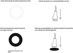 Compresibilidad y halo en arteria temporal.