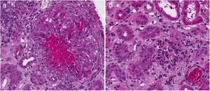 A) Penacho glomerular con necrosis fibrinoide y cariorexis asociado con una semiluna celular. B) Intersticio con fibrosis intersticial y atrofia tubular asociada con leve infiltrado inflamatorio mixto (tinción hematoxilina-eosina). Magnificación original x400.