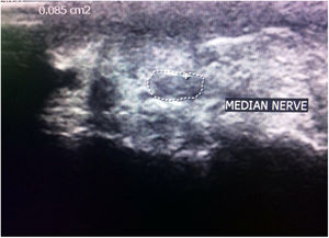 Axial gray scale U/S image at the level of the proximal carpal raw showing transverse plane of the median nerve with cross sectional area=0.85mm2.