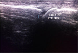 Sagittal U/S image showing the proximal interphalangeal joint of the index finger with minimal joint effusion.