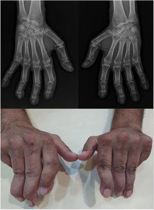 Jaccoud-type arthropathy. 40-Year-old male patient with long-standing systemic lupus erythematosus (positive ANA, anti-dsDNA, and anti-nucleosome antibodies) and triple positive antiphospholipid syndrome. Rheumatoid factor and anti-cyclic citrullinated peptide antibodies were negative. Hand deformities including ulnar drift at the metacarpophalangeal joints, swan neck and boutonnier deformities, and hyperextension of the interphalangeal joint of the thumb closely resemble those seen in rheumatoid arthritis. The absence of erosions on radiographs and their reducibility differentiates this condition from deforming arthritis of rheumatoid arthritis.