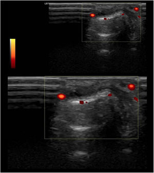 Standard ultrasound study with integration of a power Doppler module using a linear probe in a patient with SLE. Longitudinal examination at the level of the proximal interphalangeal joint indicates the presence of a discrete component of synovial effusion, irregularity and prominence of the articular component of the distal epiphysis of the proximal phalanx. The Power Doppler evaluation showed a moderate increase in vascular uptake at the joint level of synovial capsular distention and periarticular soft tissues in the distal epiphysis of the proximal phalanx. Findings suggestive of active synovitis with associated joint remodeling and active inflammatory and neovascular signs of the periarticular soft tissues.