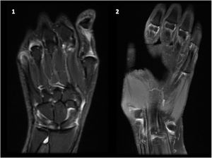 MRI of the hands and wrist. Coronal STIR sequence. Mild synovitis present in the second, third and fourth metacarpophalangeal joints and in the distal radioulnar joint. No structural or inflammatory bone damage (i.e., erosions or bone edema) was observed.