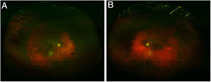 Ultra-wide fields retinography show typical “bull's eye” image on fundoscopic examination, consisting of a parafoveal ring of depigmentation of the retinal pigment epithelium (RPE) surrounded by a halo of hyperpigmentation. (A) Right eye; (B) Left eye.
