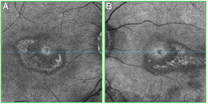 Abnormal C-Scan OCT (“en face”) with central and parafoveal changes in the ellipsoid layer in both eyes. (A) Right eye; (B) Left eye.
