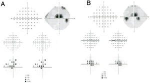 Automated 10–2 visual fields. Partial annular defect with central preservation in both eyes. (A) Right eye; (B) Left eye.