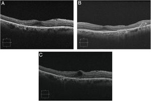 OCT image demonstrate IS-OS junction irregularity with atrophy in parafoveal temporal zone in both eyes. (A) Right eye. (B) Left eye. (C) Macular edema can be seen in advanced cases.