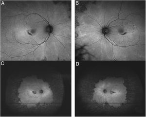 Ultra-wide field FAF image (A: Right eye; B: Left eye) demonstrates mottled hypofluorescence in all mid-periphery distribution in an advanced case of toxicity. FAF macular images (C: Right eye; D: Left eye) show parafoveal distribution in both eyes with mottled hypoautofluorescence.