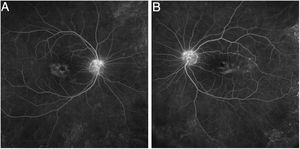 Fluorescein angiography showing bilateral macular edema. (A) Right eye; (B) Left eye.