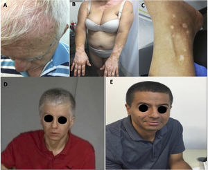 Tres pacientes con vitíligo tras inmunoterapia por melanoma A, B y C). Repigmentación de piel y cabello inducida por nivolumab, D) antes y E) después. Todas las imágenes son publicadas con consentimiento de los pacientes.