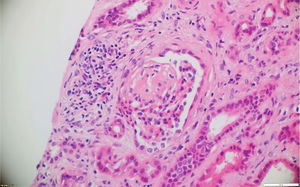 Hematoxilina y eosina. Glomérulo que presenta glomeruloesclerosis focal y segmentaria. En el intersticio se observa edema e infiltrado inflamatorio mononuclear con atrofia tubular. 10x.