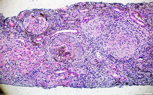 Metenamina de plata. Glomérulos con presencia de semilunas fibrocelulares y necrosis fibrinoide en el penacho glomerular. 10x.