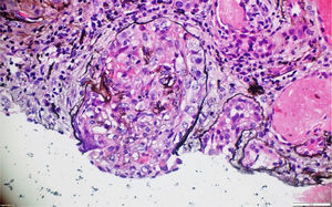 Metenamina de plata. Semiluna fibrosa con destrucción de la membrana basal glomerular y reemplazo de células epiteliales por fibroblastos en un proceso cicatricial. 40x.