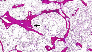 Tinción de H-E médula ósea hipocelular con áreas focales de aposición paratrabecular de hueso nuevo (flecha) 4×.