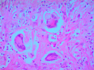 Imagen de autopsia clínica, tejido pulmonar: aumento de 40x. Muestra de células gigantes en tejido pulmonar, con evidencia de granulomas, lo que confirma el diagnóstico.