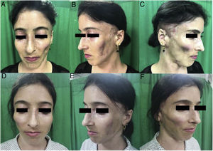 Lipoatrofia facial grado 3: vista de frente (A), de perfil izquierdo (B) y de perfil derecho (C) en preoperatorio, y vista de frente (D), de perfil izquierdo (E) y de perfil derecho (F) en postoperatorio 3 meses.