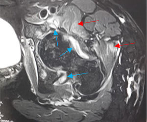 Axial T2-weighted; shows myositis of adductor muscles (red arrows) and increased intra-articular coxofemoral fluid in left hip (blue arrows).