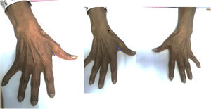A) Atrofia del primer interóseo dorsal, mano derecha (flechas). B) Manos comparadas. Se observa mayor atrofia del primer interóseo dorsal de la mano derecha.