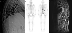 A) Radiología simple, con fractura-aplastamiento del cuerpo vertebral de D12 (flecha). B) Gammagrafía ósea con lesiones de elevada actividad osteoblástica en troquíter humeral derecho (asterisco) y columna dorsolumbar (niveles D12-L2) (flecha). C) RM de columna dorsolumbar, en la que se observa espondiloartritis degenerativa en columna dorsolumbar; espondilodiscitis D11-D12-L1, con osteólisis del cuerpo vertebral de D12 y absceso intraóseo (flecha); retrolistesis de D12 y superiores con deformidad del cordón medular y estenosis del canal sin signos de mielopatía (punta de flecha).