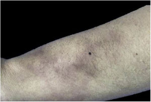 Múltiples nódulos eritematovioláceos confluentes en miembro superior.